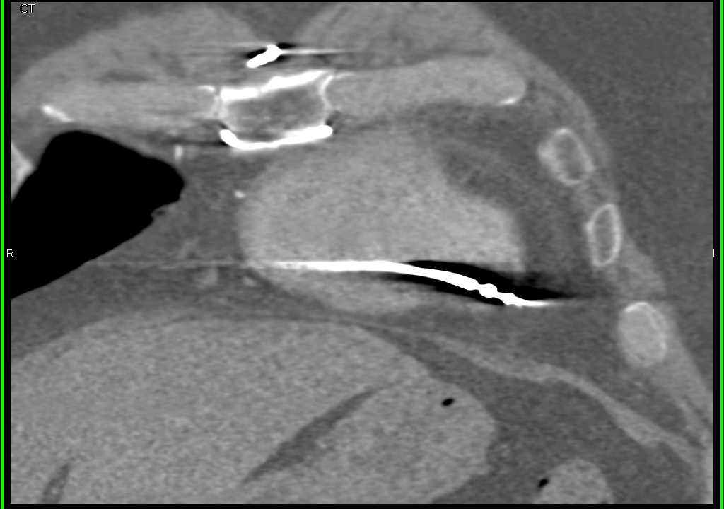 Distal Wire from Pacemaker Goes Through the Wall of the Ventricle - CTisus CT Scan