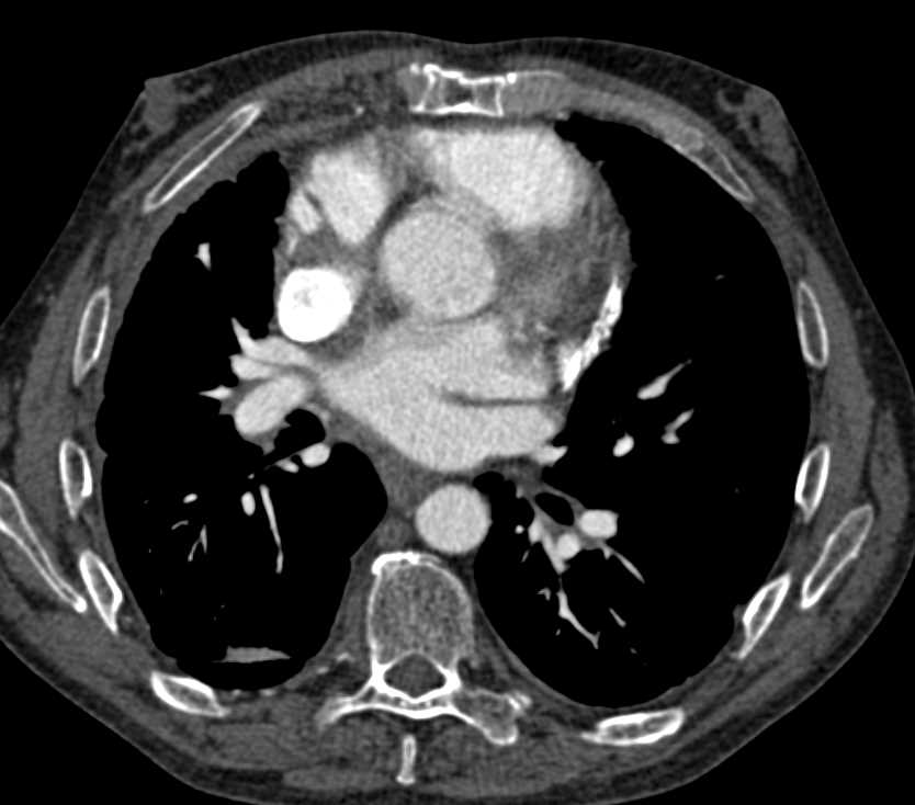 Constrictive Pericarditis - CTisus CT Scan