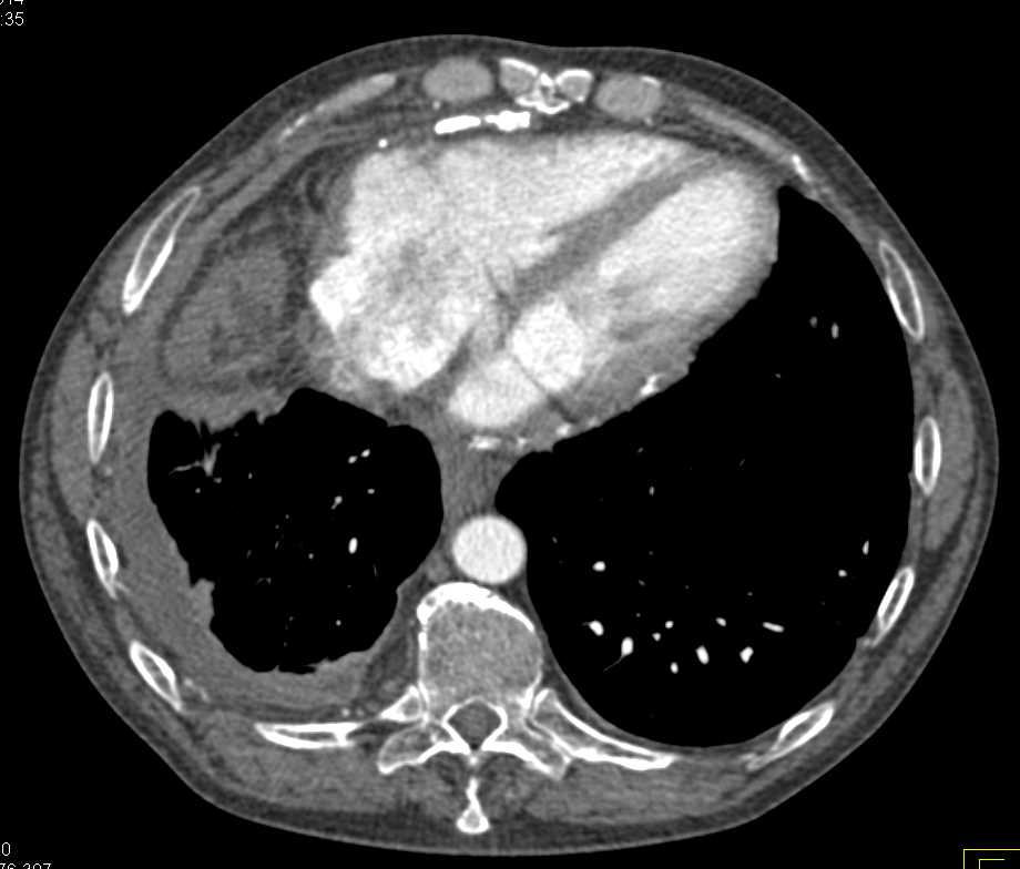 Constrictive Pericarditis - CTisus CT Scan