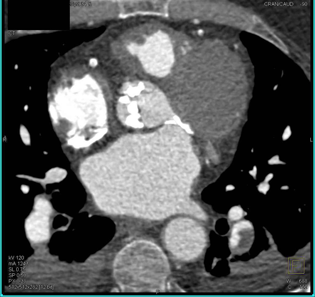 Aortic Valve Calcification with Aortic Stenosis as well as Pulmonary Embolism - CTisus CT Scan