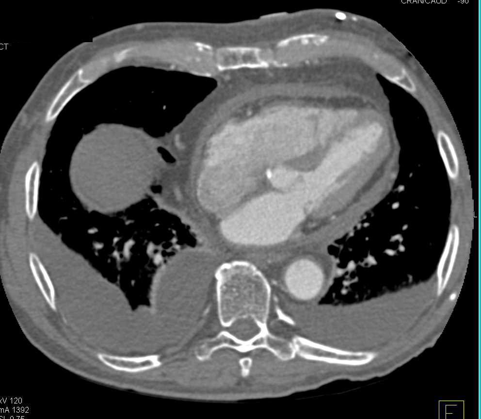 Constrictive Pericarditis - CTisus CT Scan
