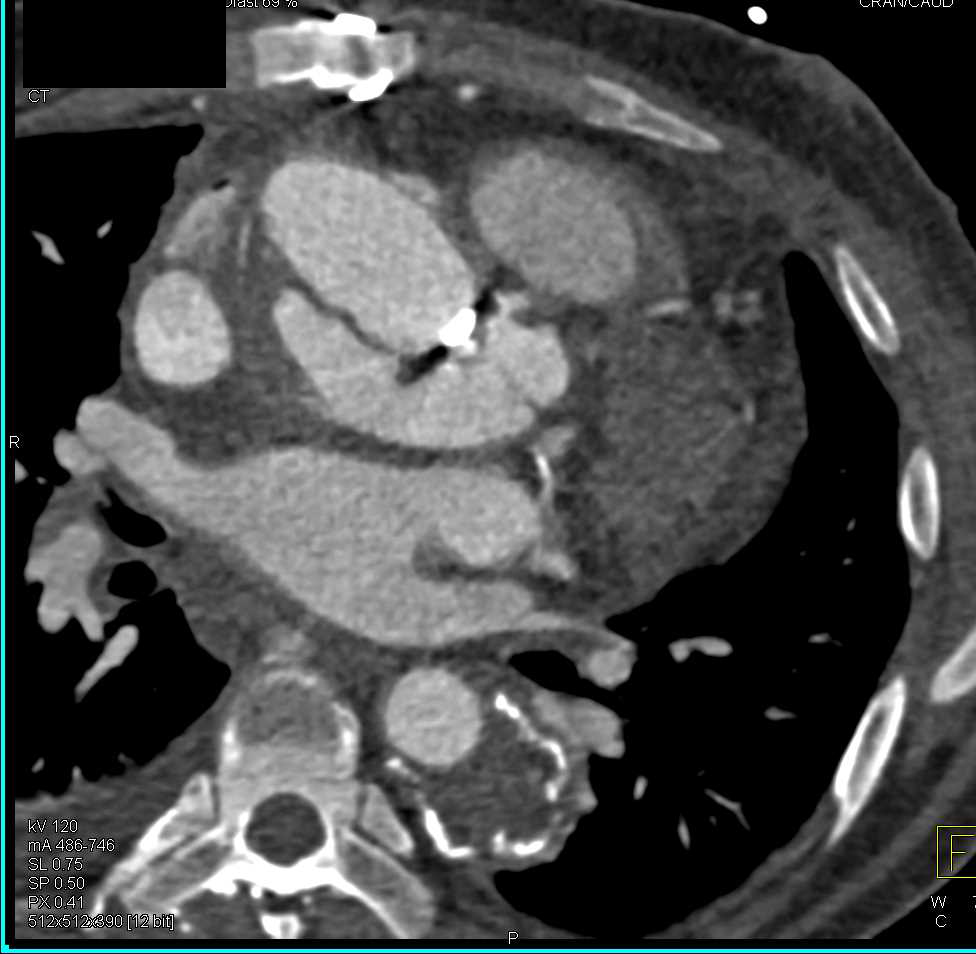 Aortic Pseudoaneurysm Following Root Repair - CTisus CT Scan