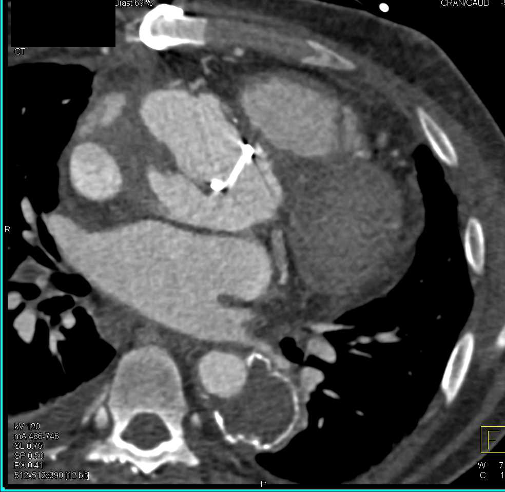 Aortic Pseudoaneurysm Following Root Repair with Aortic Valve Replacement (AVR) - CTisus CT Scan