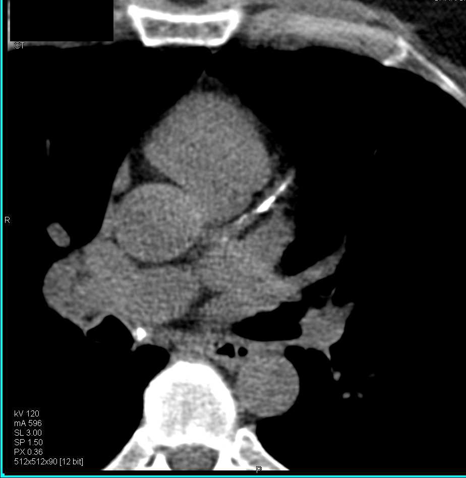 CCTA with Critical Stenosis in Left Anterior Descending Coronary Artery (LAD) and Right Coronary Artery (RCA) - CTisus CT Scan
