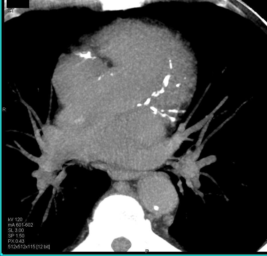 CCTA: Extensive Coronary Artery Disease in a Patient with Chest Pain - CTisus CT Scan