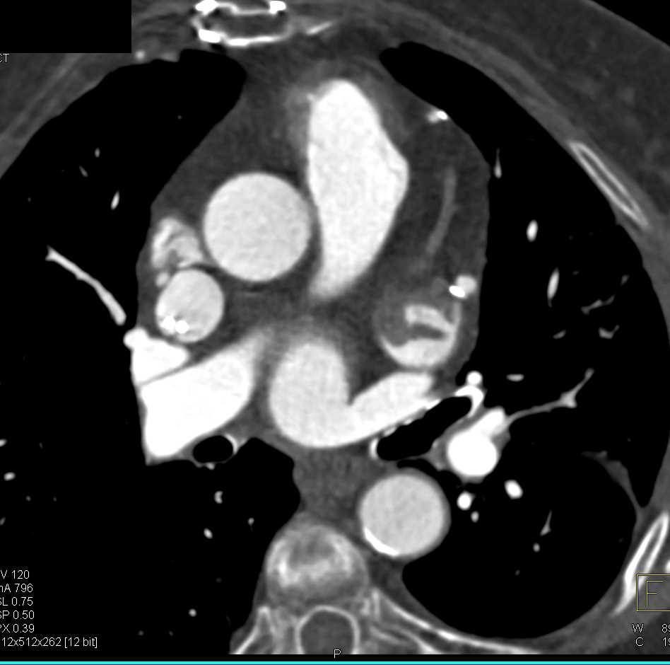 Thrombus in the Left Atrial Appendage - CTisus CT Scan
