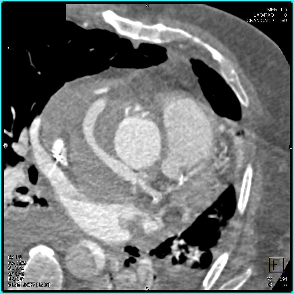 Reimplanted Left Main Coronary Artery - CTisus CT Scan