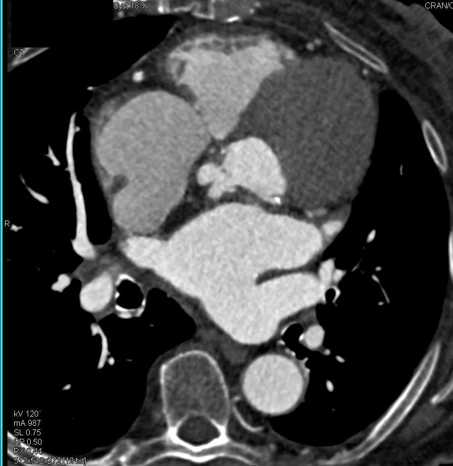 Mitral Annular Calcification - CTisus CT Scan