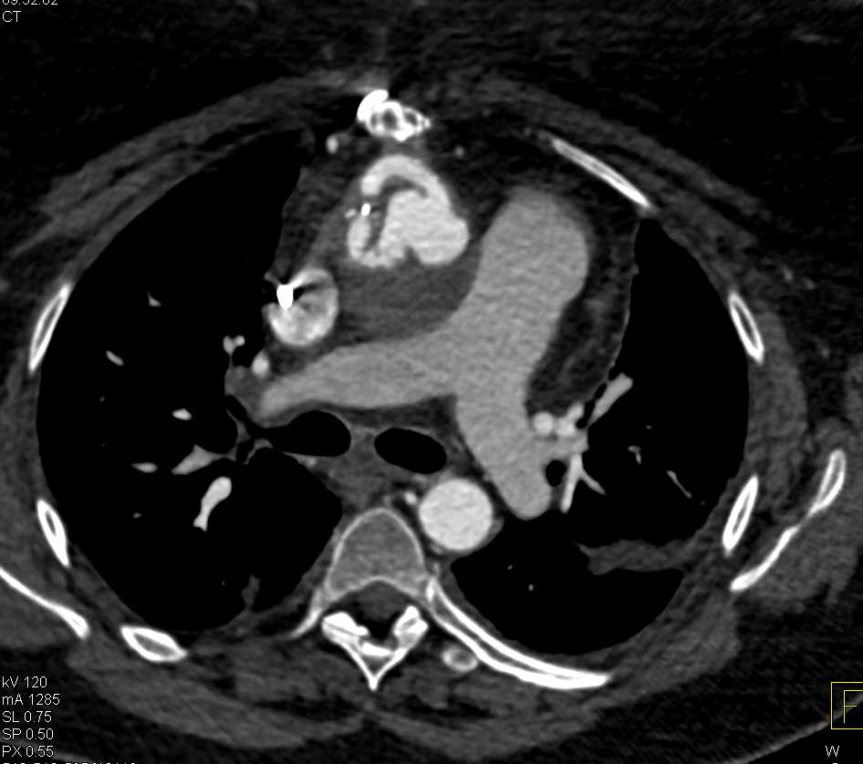 Type A Dissection with Repair - CTisus CT Scan