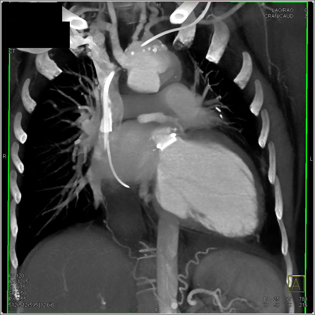 Type A Dissection with Repair and Reimplantation of the Coronary Arteries - CTisus CT Scan