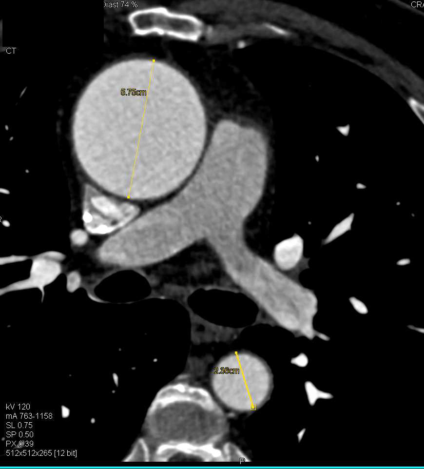 Aortic Valve Replacement (AVR) with a Dilated Ascending Aorta - CTisus CT Scan