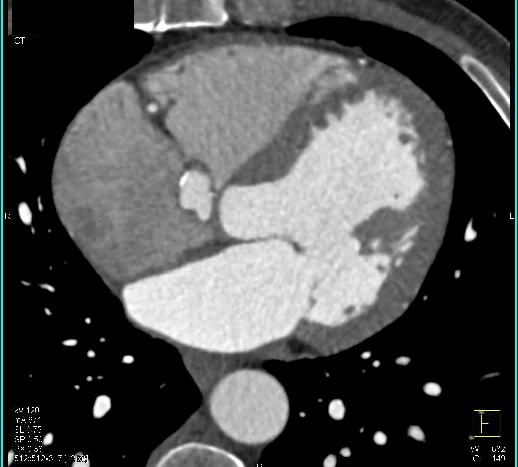 Pseudoaneurysm Aortic Root s/p Aortic Valve Replacement (AVR) - CTisus CT Scan