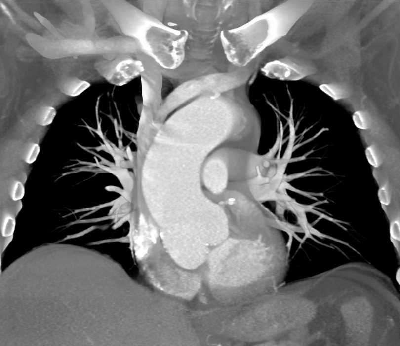 Calcified Bicuspid Aortic Valve with Dilated Ascending Aorta - CTisus CT Scan
