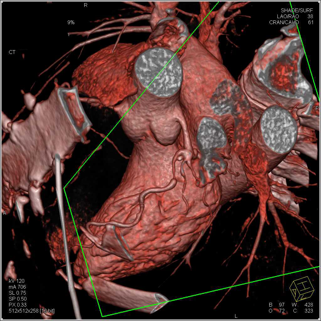 CCTA: High Grade Stenosis in the Left Anterior Descending Coronary Artery (LAD) - CTisus CT Scan