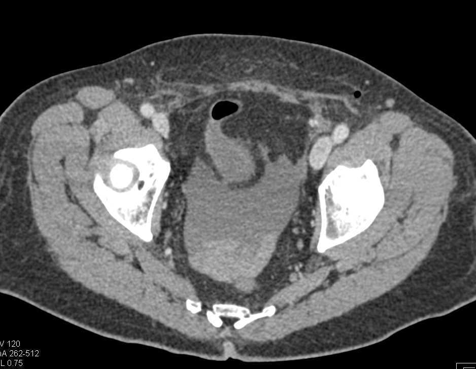 CCTA: Malignant Configuration of the Right Coronary Artery (RCA) off the Left Cusp - CTisus CT Scan