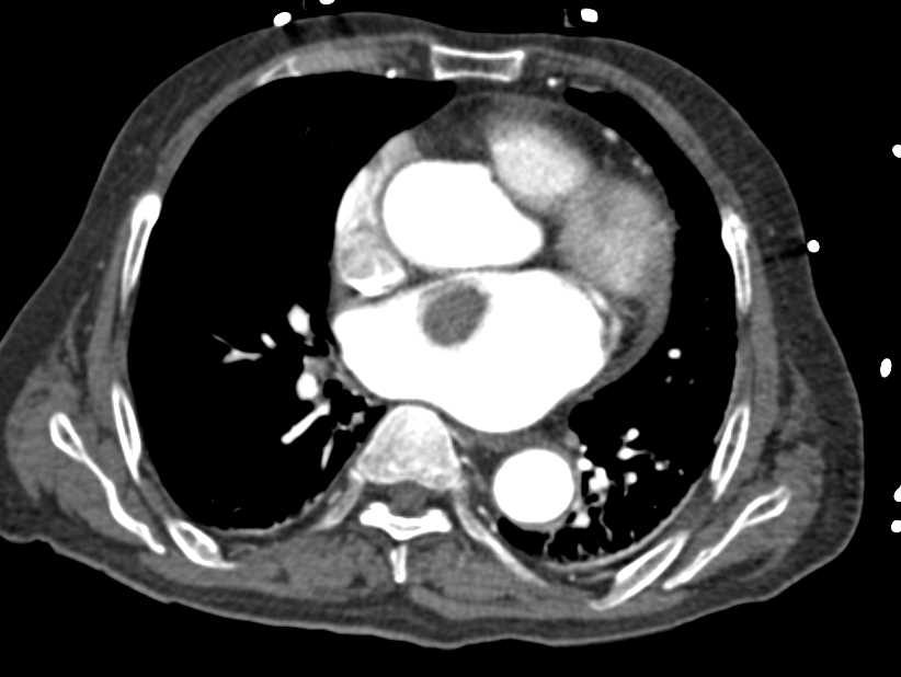 Left Atrial Thrombus and Occlusion of the Left Superficial Femoral Artery (SFA) - CTisus CT Scan