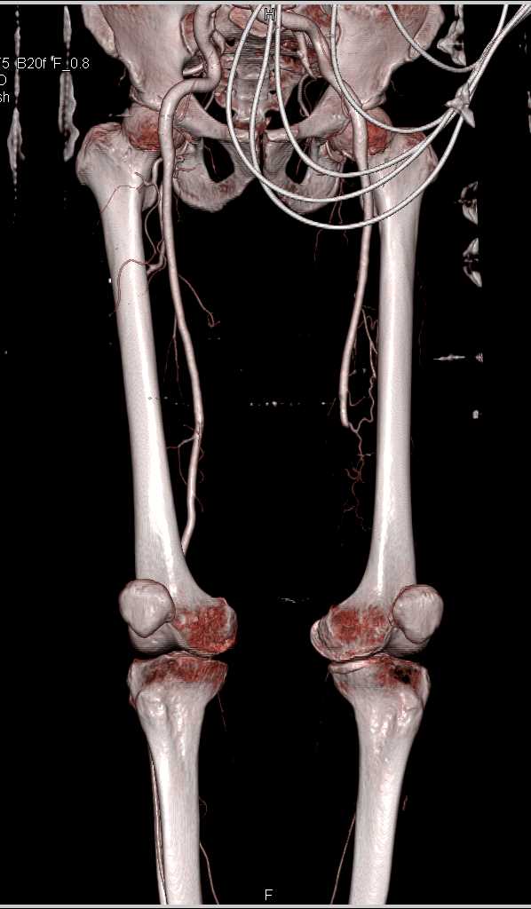 Left Atrial Thrombus and Pulmonary Embolism (PE) and Occlusion of the Left Superficial Femoral Artery (SFA) - CTisus CT Scan