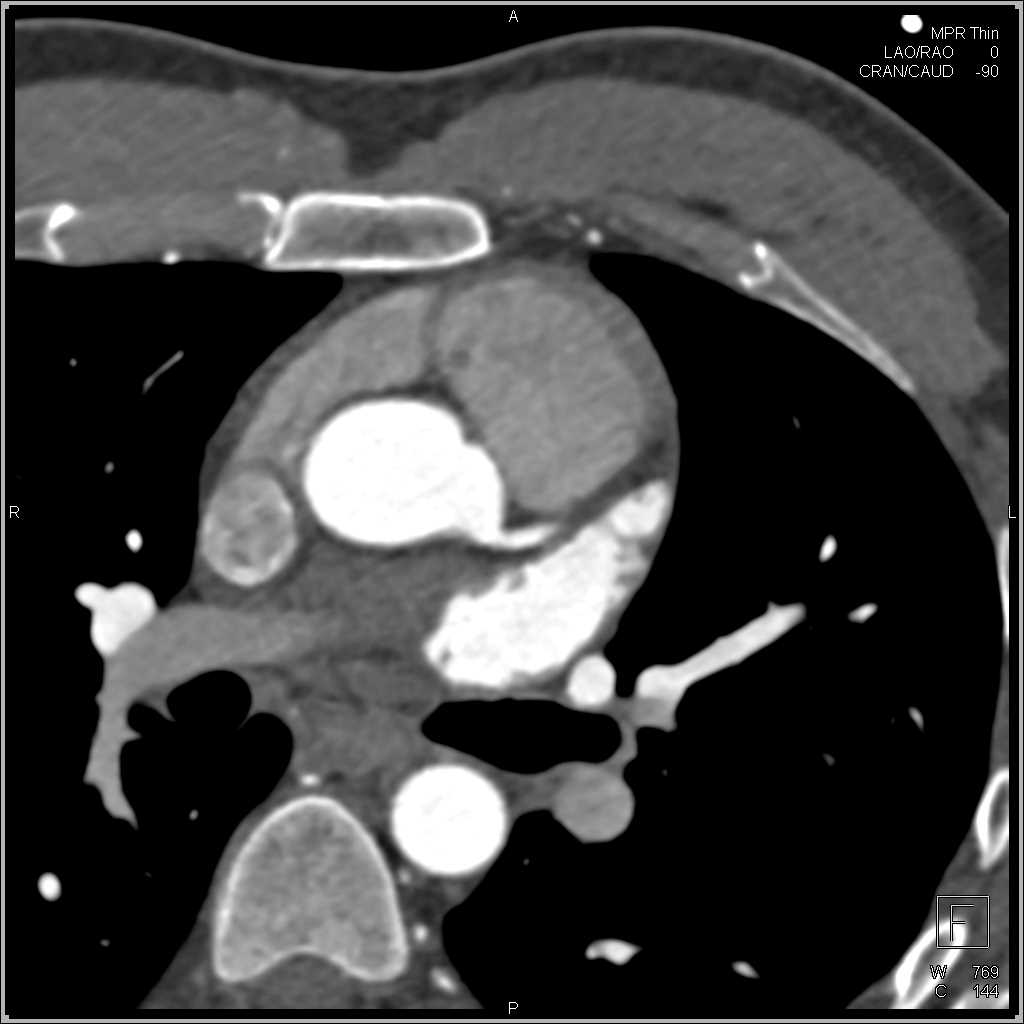 Anomalous Course of Coronary Artery in 3D - CTisus CT Scan