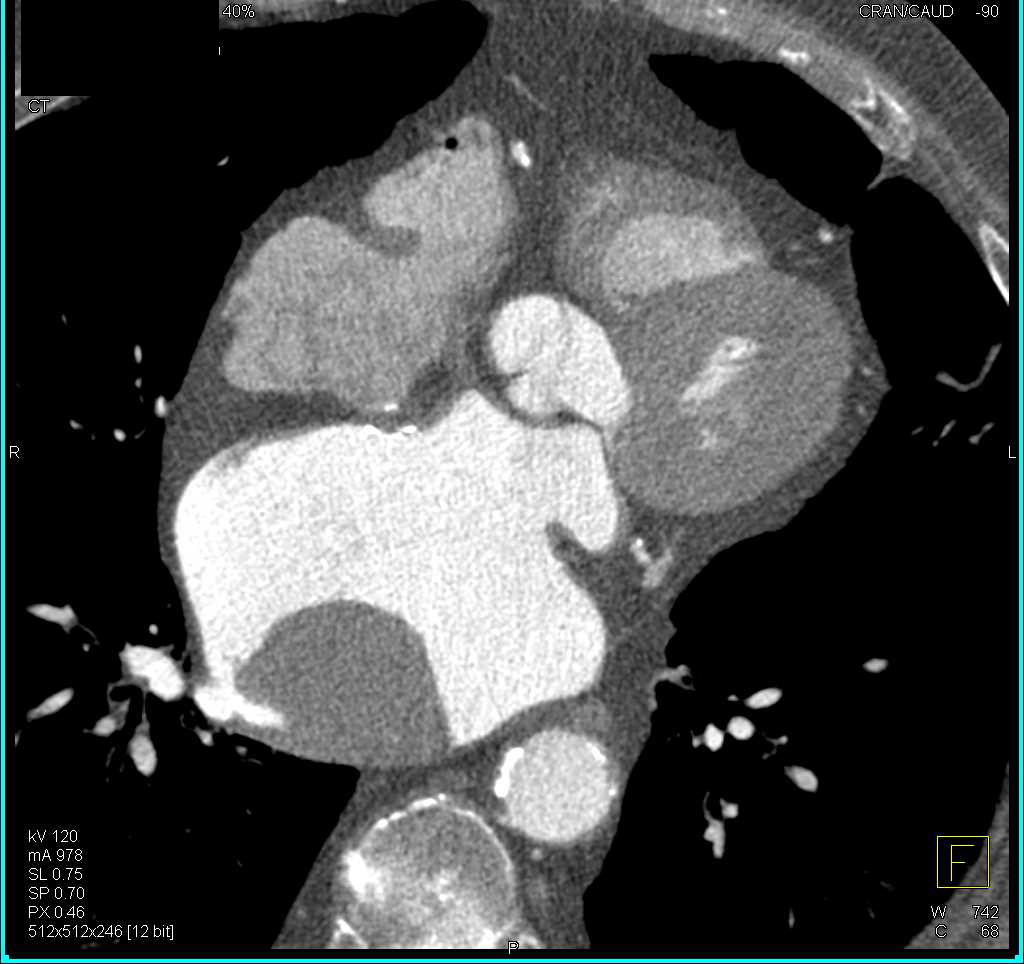 Left Atrial Myxoma - CTisus CT Scan