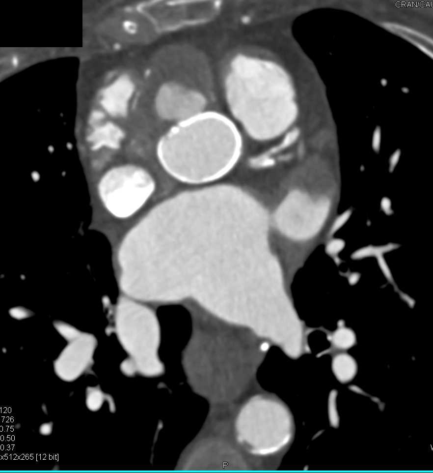 Pseudoaneurysm off the Aortic Root - CTisus CT Scan