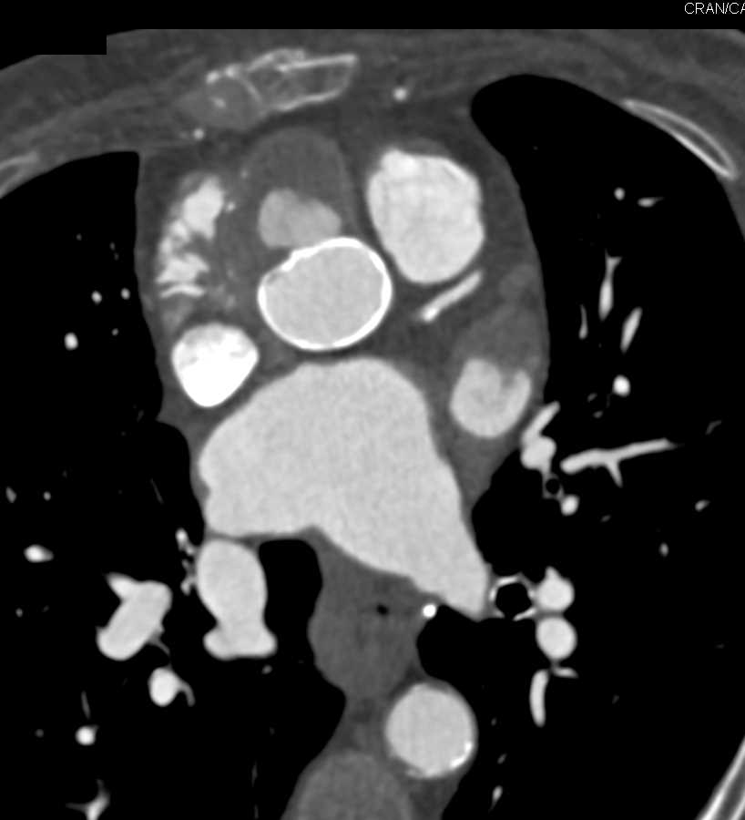 Pseudoaneurysm off the Aortic Root - CTisus CT Scan