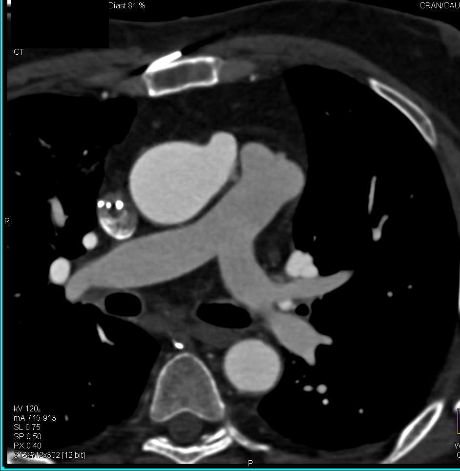 Focal Aneurysm Aorta at Trocar Site - CTisus CT Scan