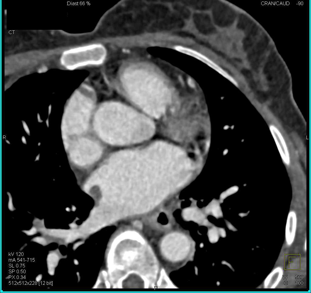 Left Atrial Thrombus - CTisus CT Scan