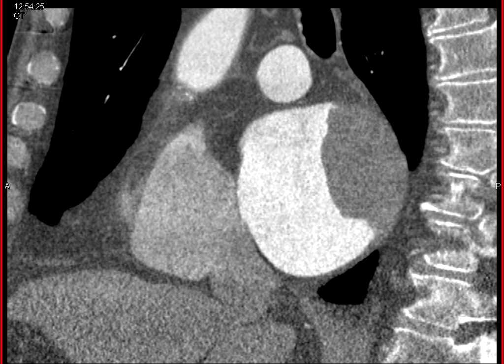 Left Atrial Myxoma - CTisus CT Scan