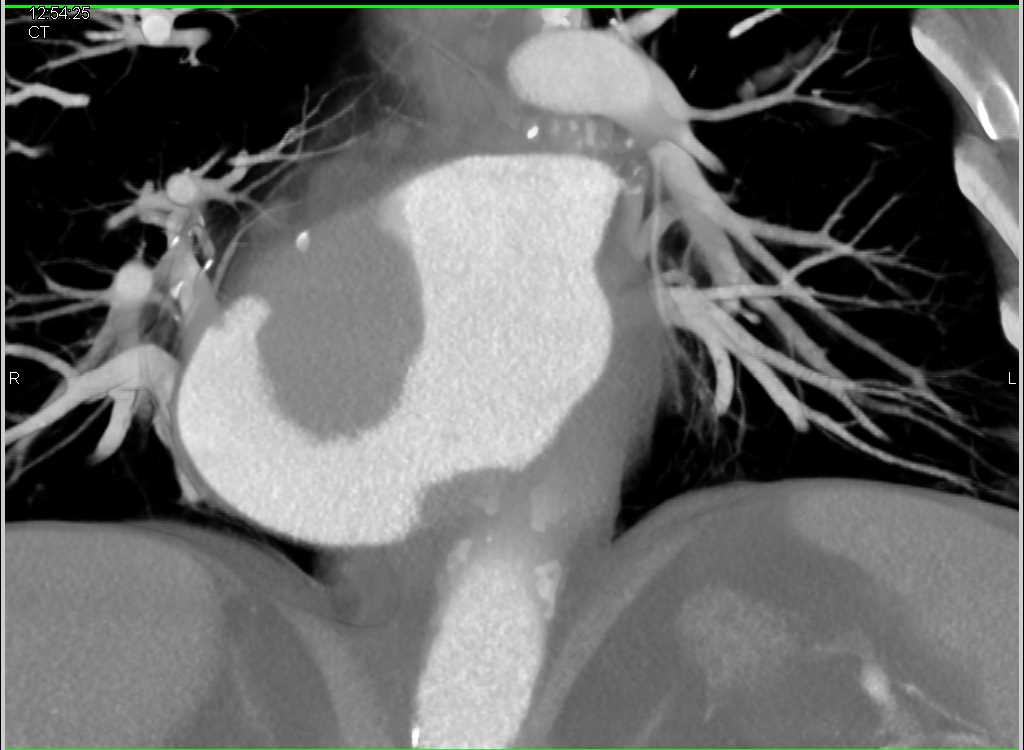 Left Atrial Myxoma - CTisus CT Scan