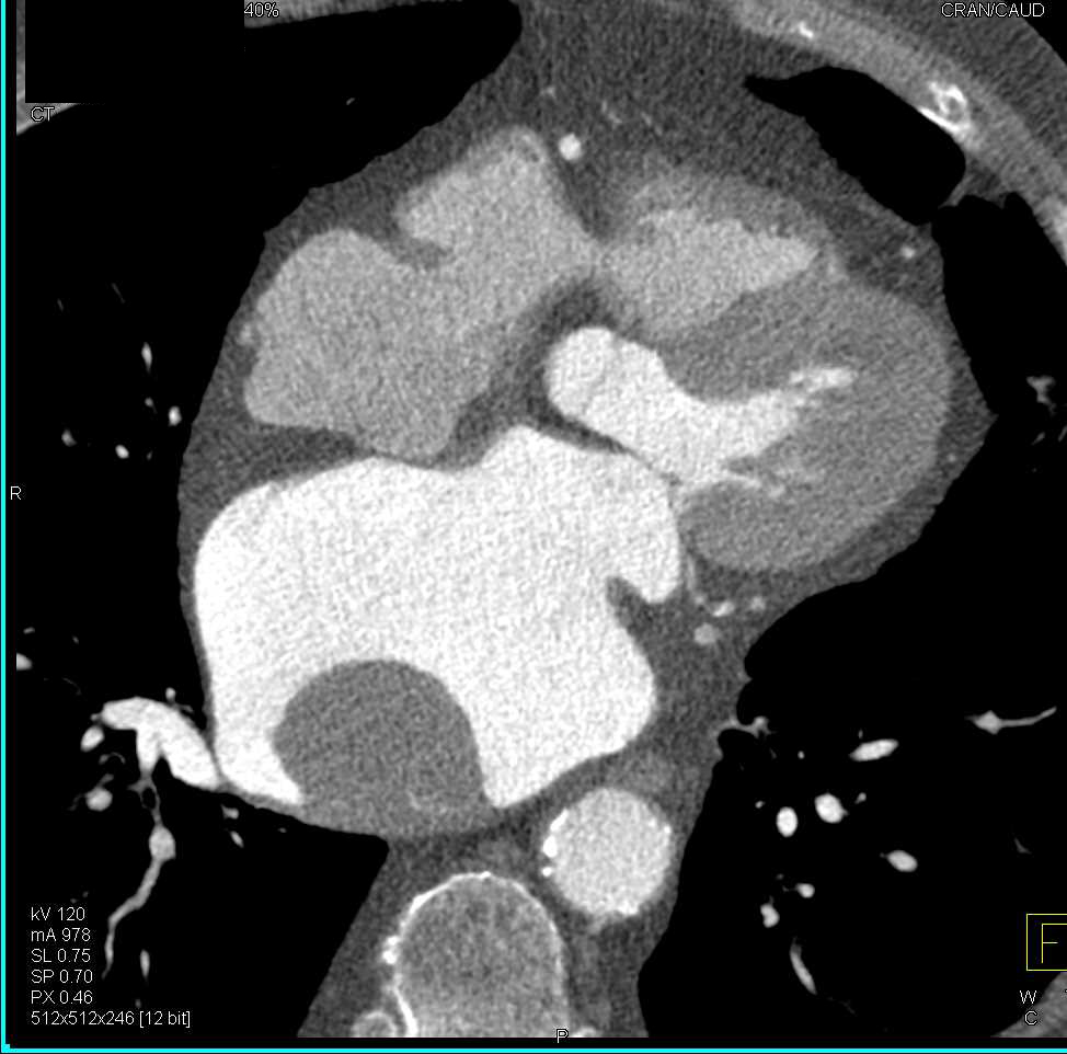 Left Atrial Myxoma - CTisus CT Scan