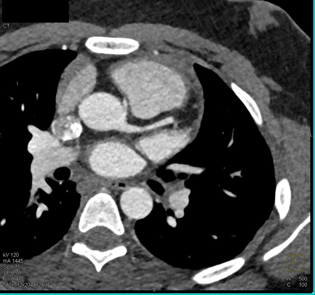 CCTA: Aberrant Right Coronary Artery Arises off Left Cusp in a Malignant Configuration - CTisus CT Scan