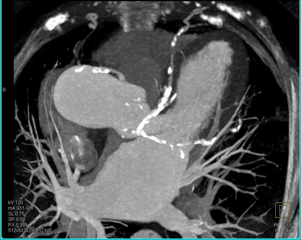 Extensive Coronary Artery Calcification Cardiac Case Studies CTisus 