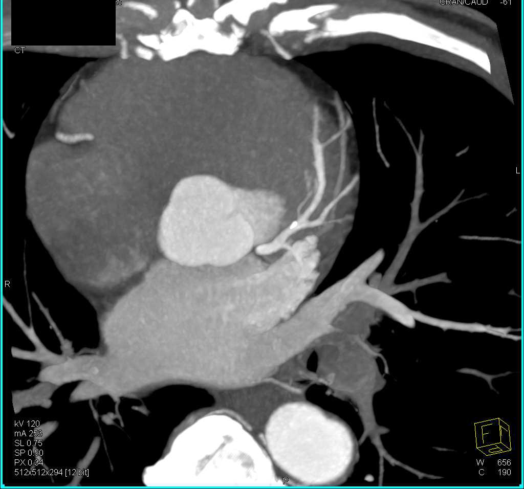 CCTA: Left Anterior Descending Coronary Artery (LAD) Plaque with Mild Stenosis - CTisus CT Scan