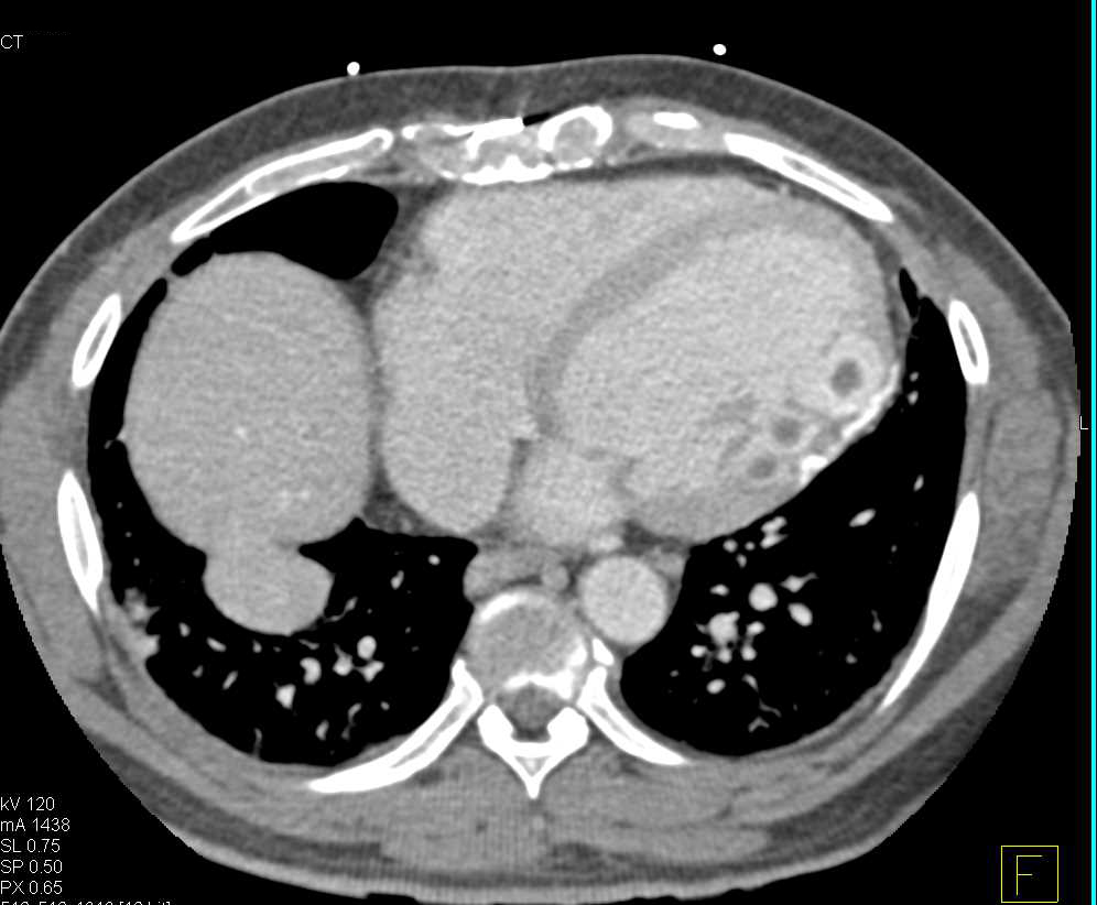 Infarct with Calcification Left Ventricle Wall - CTisus CT Scan