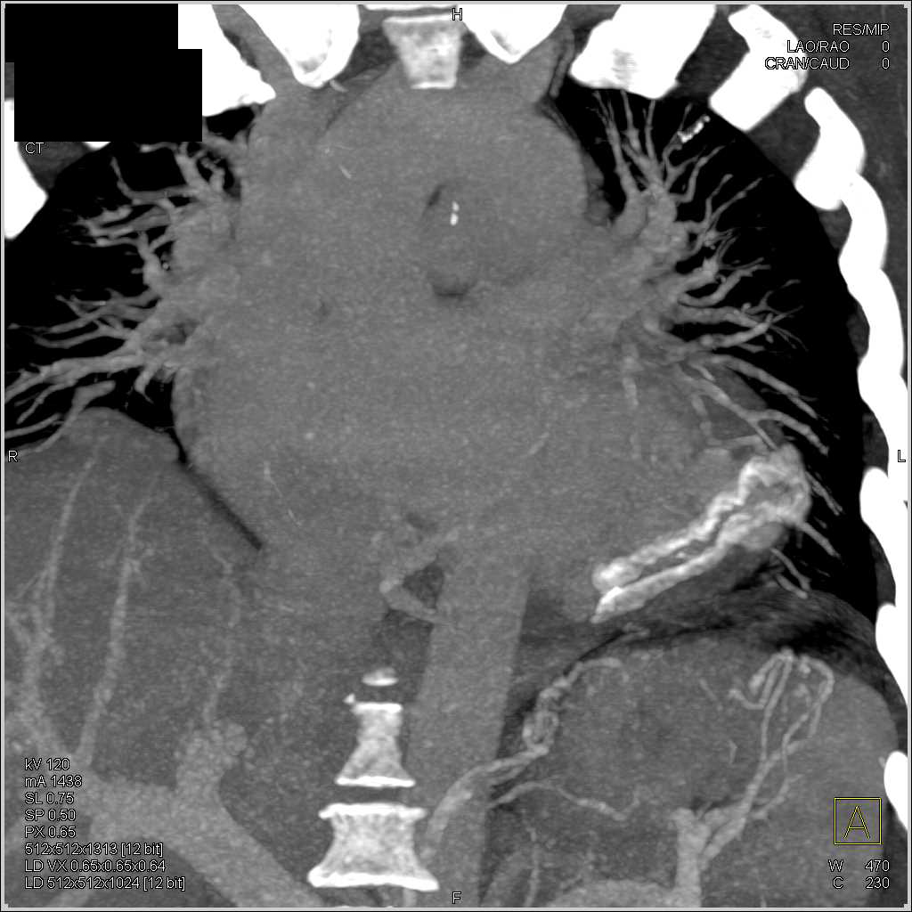 Foreign Material Near Left Ventricle - CTisus CT Scan