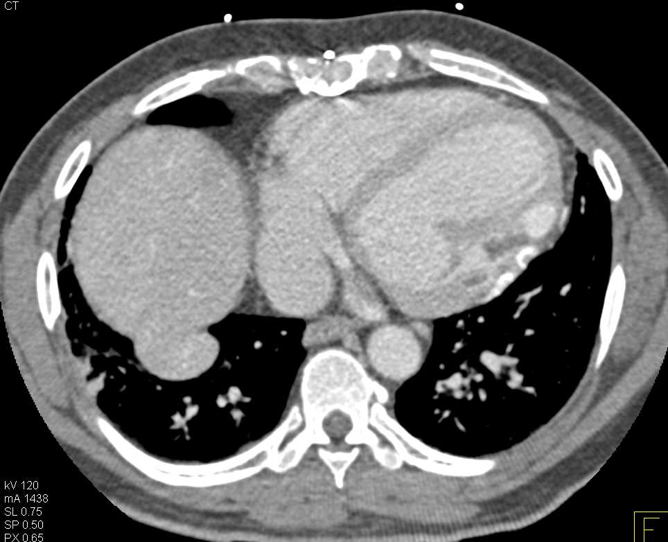 Foreign Material Near Left Ventricle - CTisus CT Scan