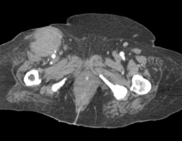 Right Thigh Hematoma in Patient with Aortic Stenosis and Here for a Transcatheter Aortic Valve Replacement (TAVR) - CTisus CT Scan