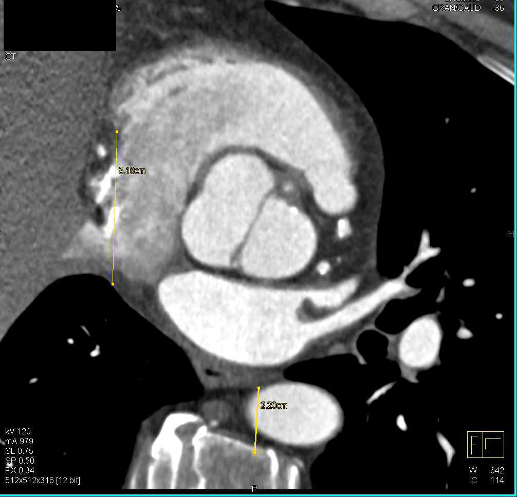 Bicuspid Aortic Valve with Early Stenosis - CTisus CT Scan