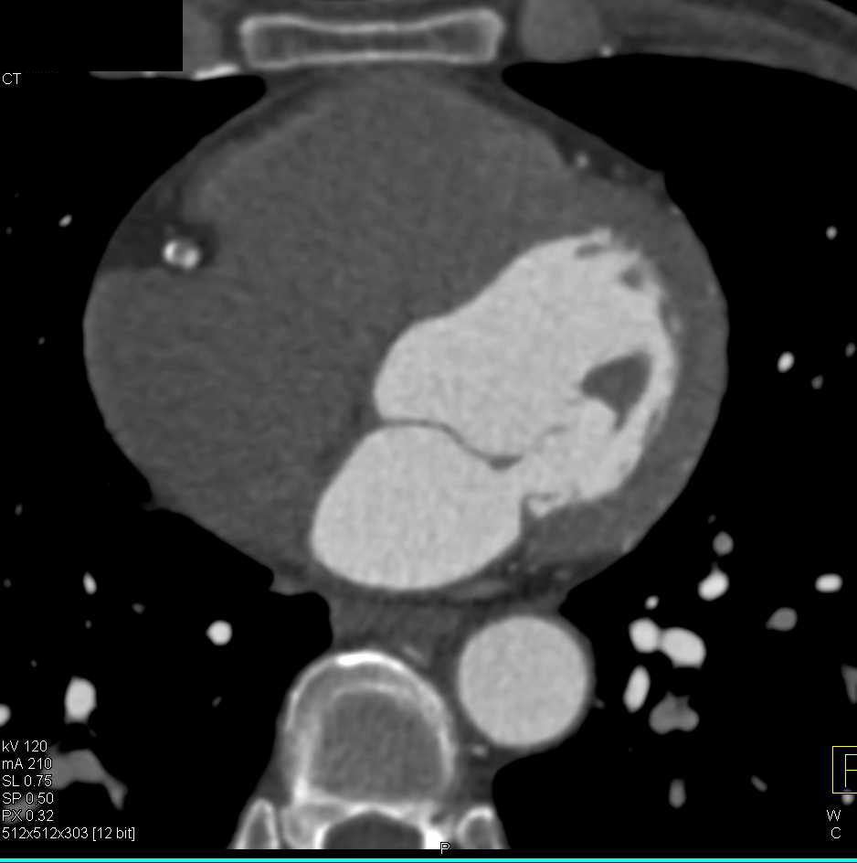 CCTA with Multi-vessel Coronary Artery Disease (CAD) with Near Occlusion of the Left Anterior Descending Coronary Artery (LAD) - CTisus CT Scan