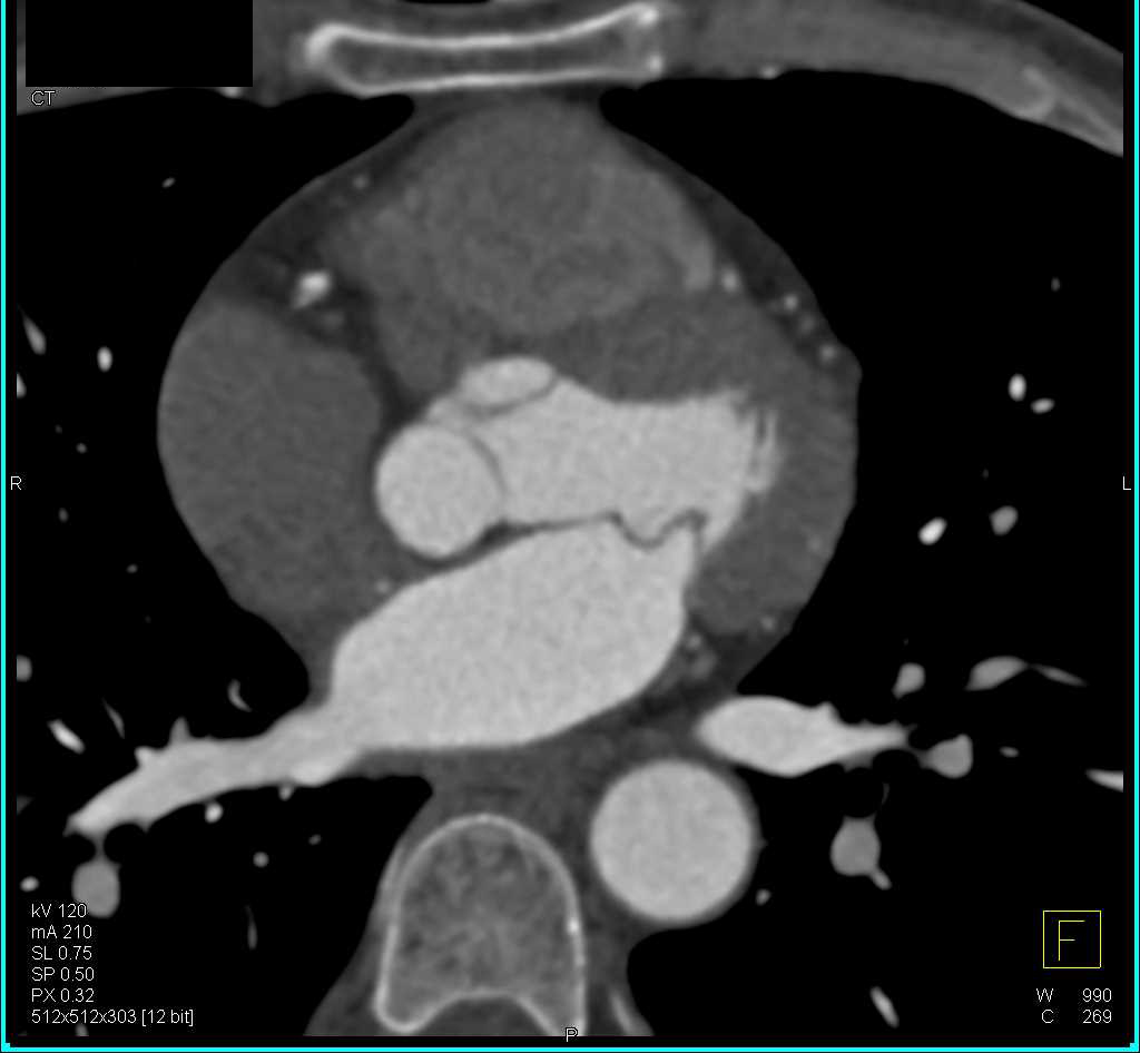 CCTA with Multi-vessel Coronary Artery Disease (CAD) with Near Occlusion of the Left Anterior Descending Coronary Artery (LAD) - CTisus CT Scan