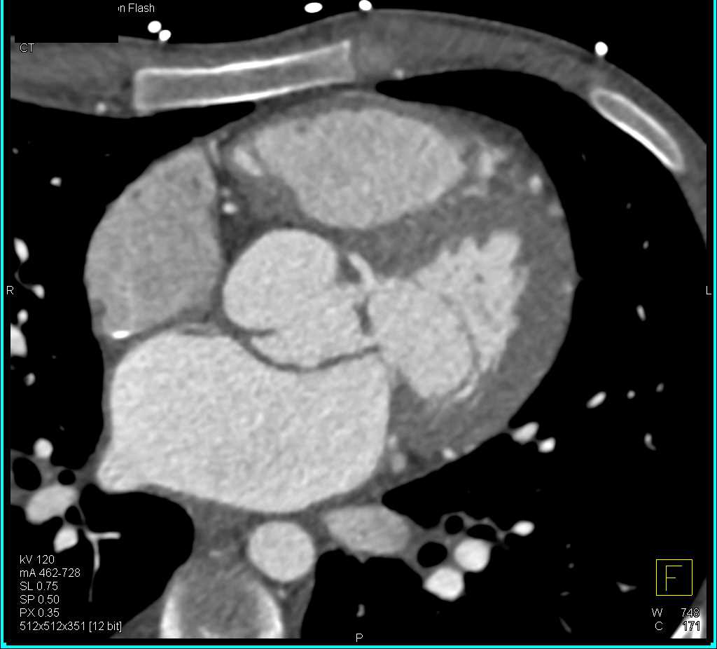 Aortic Valve Disease with Thickened Valve Leaflets - CTisus CT Scan