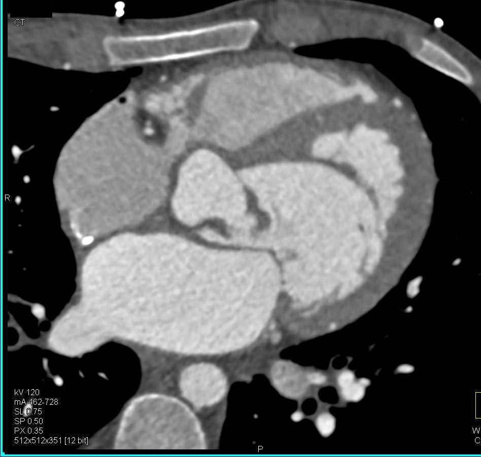 Aortic Valve Disease with Thickened Valve Leaflets - CTisus CT Scan