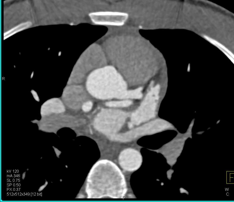 Coronary Artery Fistulae from Circumflex Coronary Artery to Right Atrium/Superior Vena Cava (SVC) Junction - CTisus CT Scan