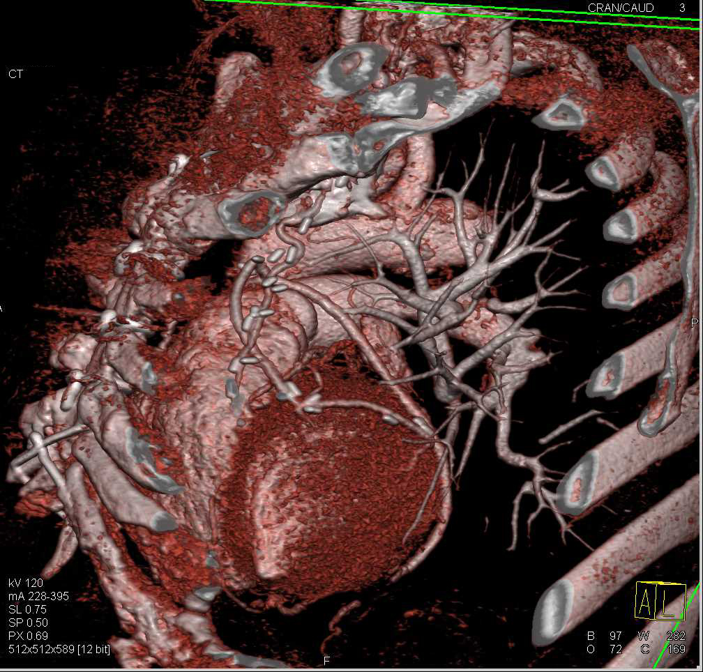 Coronary Artery Bypass Grafts - CTisus CT Scan