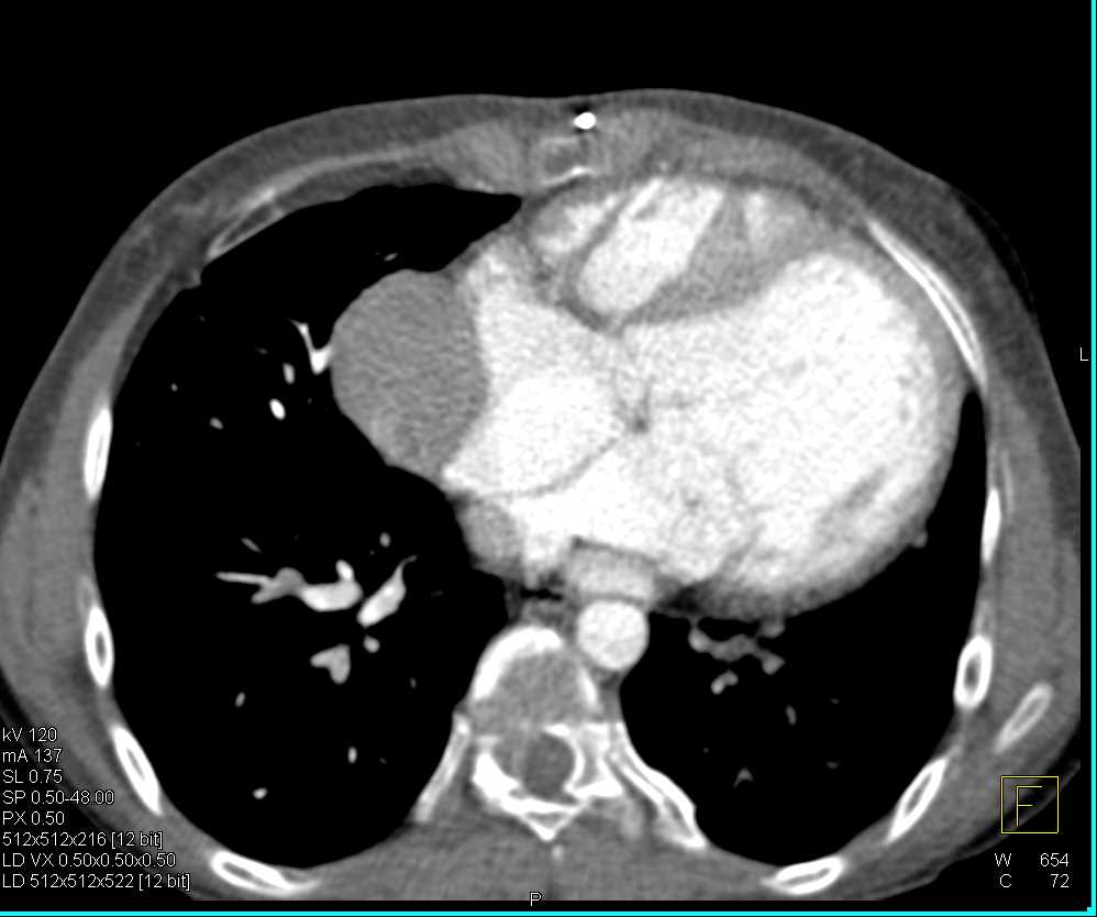 Angiosarcoma of the Pericardium - CTisus CT Scan