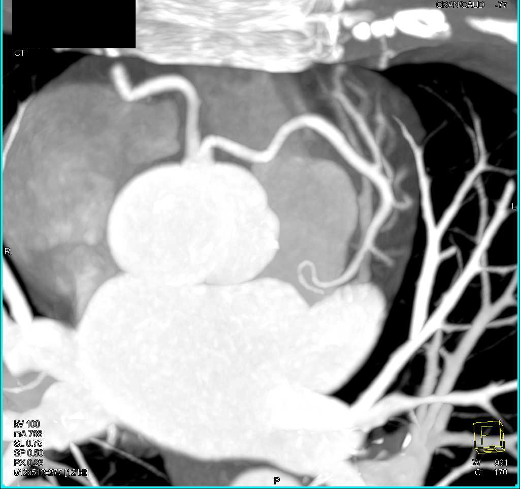 Left Coronary Artery Arises off the Right Cusp - CTisus CT Scan