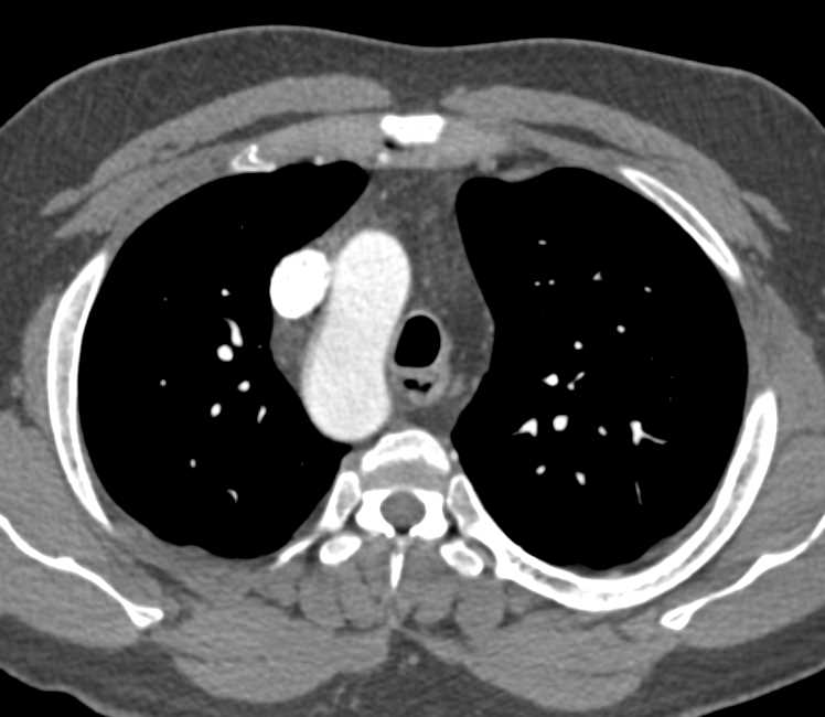 Right Aortic Arch with Classic Branch Vessel Anatomy - Cardiac Case ...