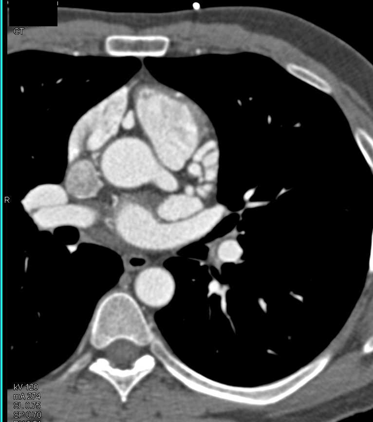 RCAPA or Anomalous Origin of the Right Coronary Artery off the Pulmonary Artery - CTisus CT Scan