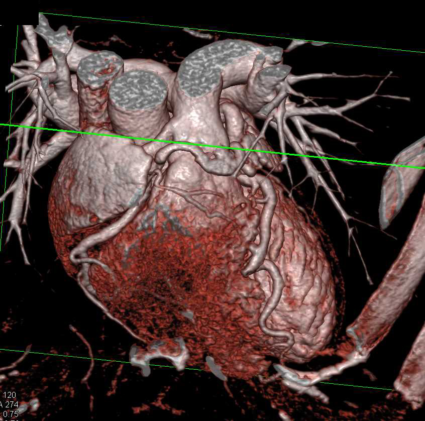 RCAPA or Anomalous Origin of the Right Coronary Artery off the Pulmonary Artery - CTisus CT Scan