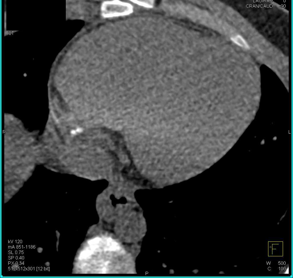 Thrombus Right Atrium Which Embolized and Resulted in Ischemic Bowel - CTisus CT Scan